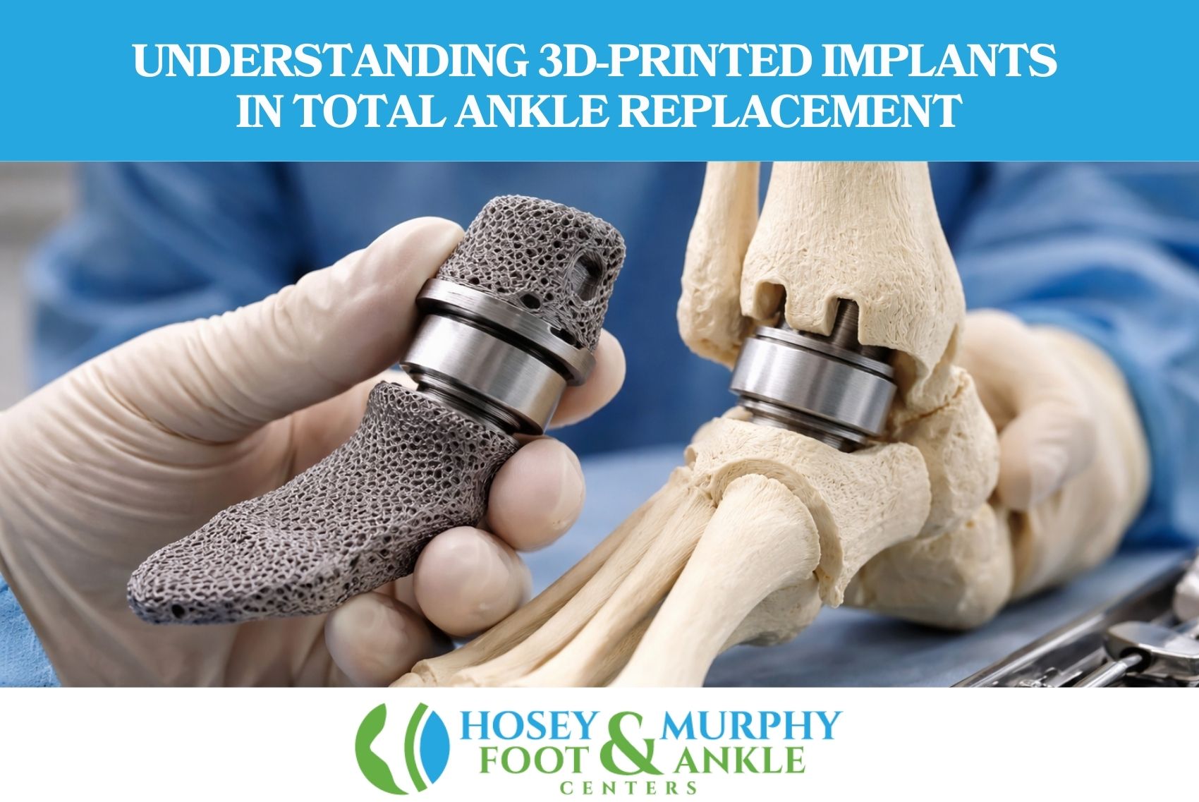 Understanding 3D-Printed Implants in Total Ankle Replacement
